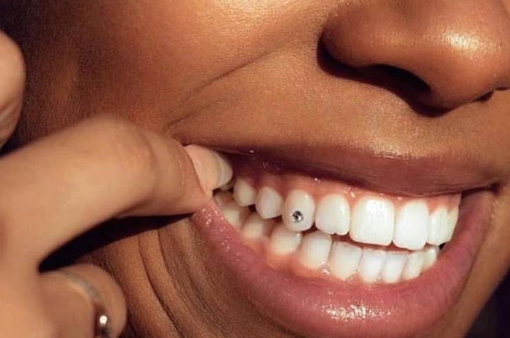 tooth gem