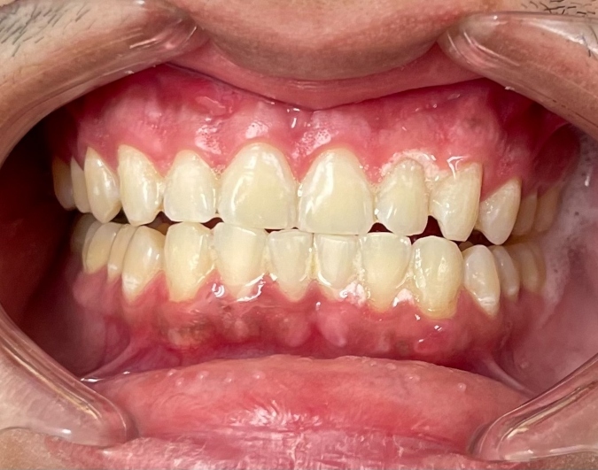 Teeth-Whitening Minneapolis MN