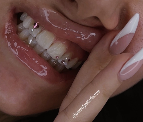 teeth gems